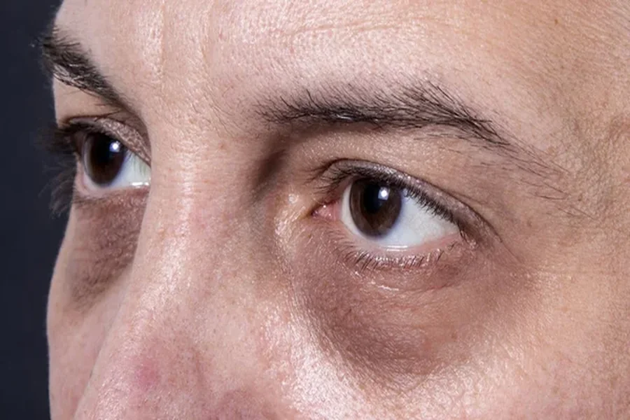Dark Eye Circle Removal